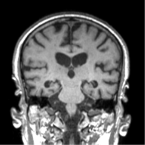 Alzheimer disease and cerebral amyloid angiopathy (Radiopaedia 64234-73011 Coronal T1 27).png