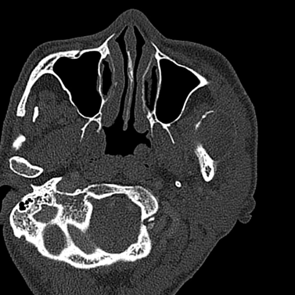 Ameloblastoma (Radiopaedia 51921-57766 Axial bone window 129).jpg