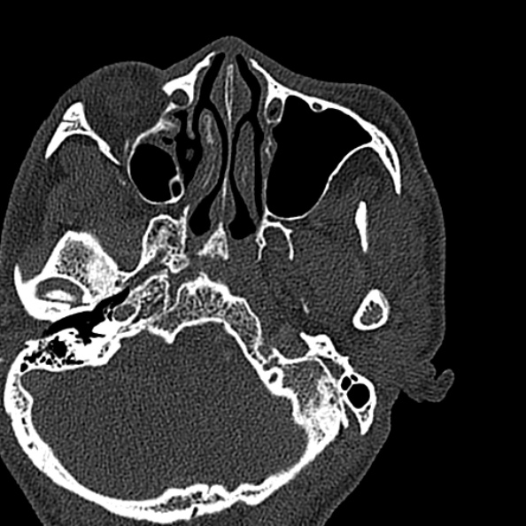 Ameloblastoma (Radiopaedia 51921-57766 Axial bone window 144).jpg
