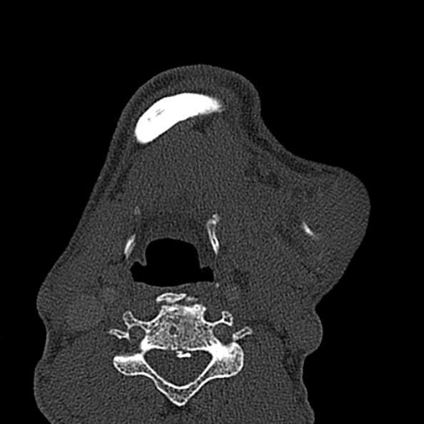 Ameloblastoma (Radiopaedia 51921-57766 Axial bone window 20).jpg