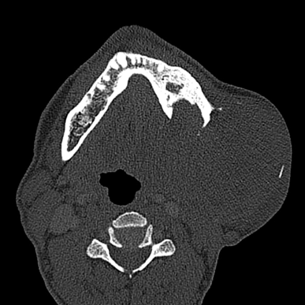 Ameloblastoma (Radiopaedia 51921-57766 Axial bone window 53).jpg