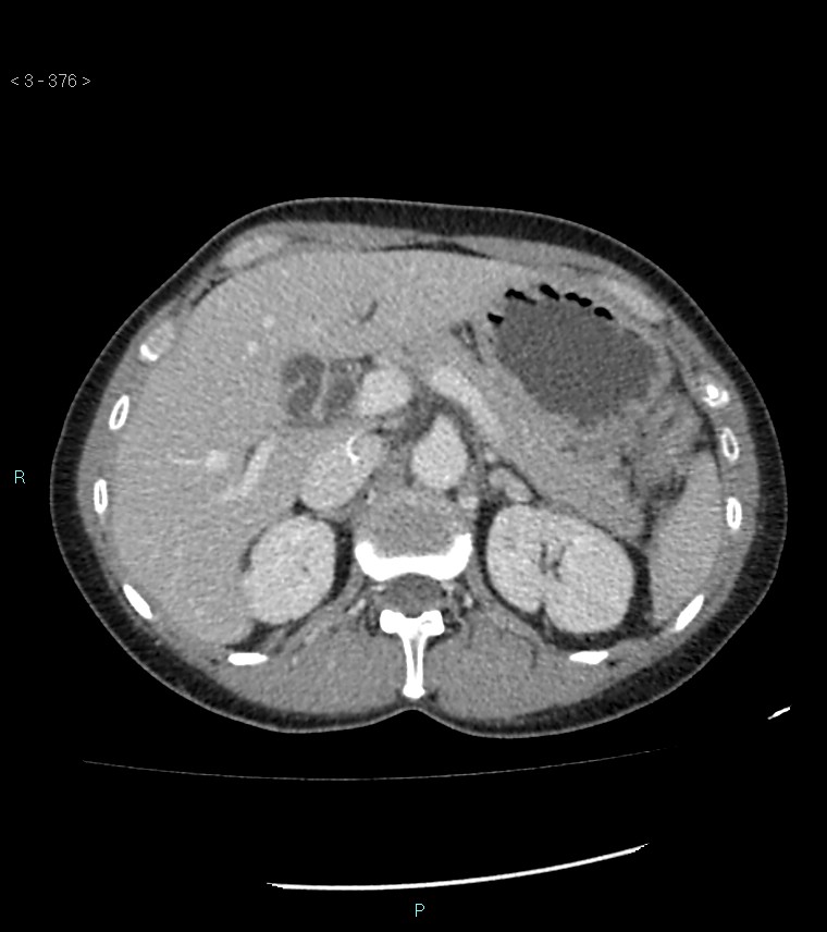 Ampulla of Vater metastasis (Radiopaedia 27820-28069 A 14).jpg