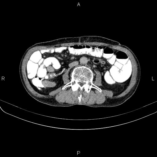 Ampullary adenocarcinoma (Radiopaedia 86093-102033 Axial C+ delayed 70).jpg