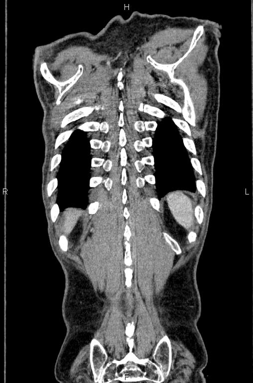 Ampullary adenocarcinoma (Radiopaedia 86093-102033 D 57).jpg