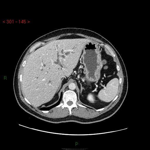 Ampullary carcinoma (Radiopaedia 56396-63056 C 24).jpg