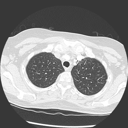 Amyloidosis - bronchial and diffuse nodular pulmonary involvement (Radiopaedia 60156-67745 Axial lung window 12).jpg