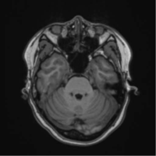 Anaplastic astroblastoma (Radiopaedia 55666-62194 Axial T1 22).png