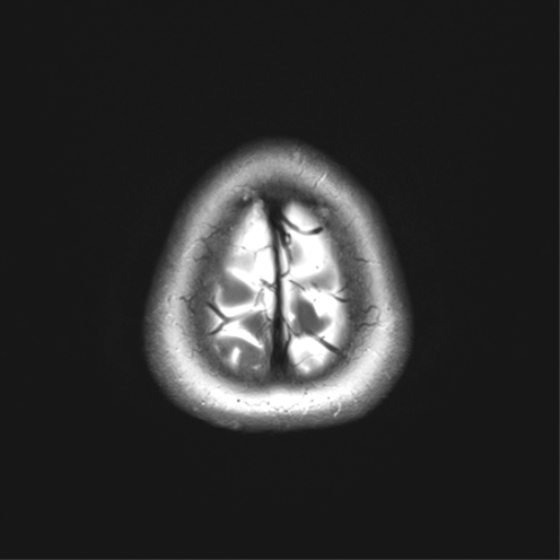 File:Anaplastic astrocytoma (Radiopaedia 86943-103160 Axial T2 36).png