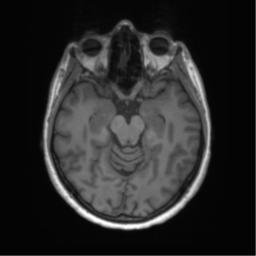 File:Anaplastic astrocytoma - thalamic glioma (Radiopaedia 59709-67115 Axial T1 6).png