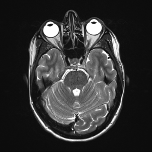 File:Anaplastic astrocytoma IDH mutant (Radiopaedia 50046-55341 Axial T2 13).png