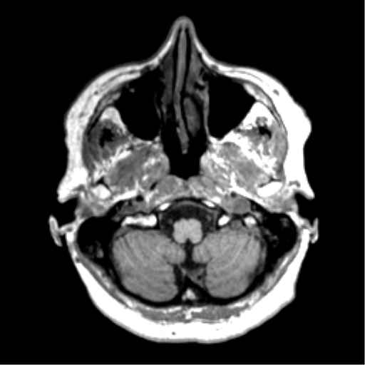 Anaplastic astrocytoma IDH wild-type (pseudoprogression) (Radiopaedia 42209-45277 Axial T1 16).png