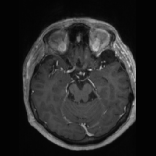 File:Anaplastic astrocytoma IDH wild-type (pseudoprogression) (Radiopaedia 42209-45277 Axial T1 C+ 44).png