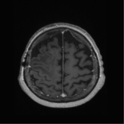 File:Anaplastic astrocytoma IDH wild-type (pseudoprogression) (Radiopaedia 42209-45278 Axial T1 C+ 123).png