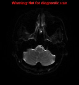 File:Anaplastic ganglioglioma (Radiopaedia 44921-48831 Axial DWI 35).jpg
