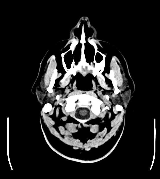 Anaplastic oligodendroglioma (Radiopaedia 79571-92753 Axial non-contrast 5).jpg