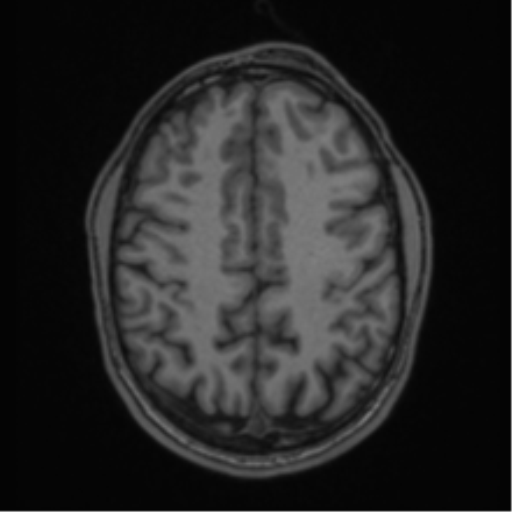 Anaplastic oligodendroglioma with skull fracture (Radiopaedia 74831-85845 Axial T1 47).png
