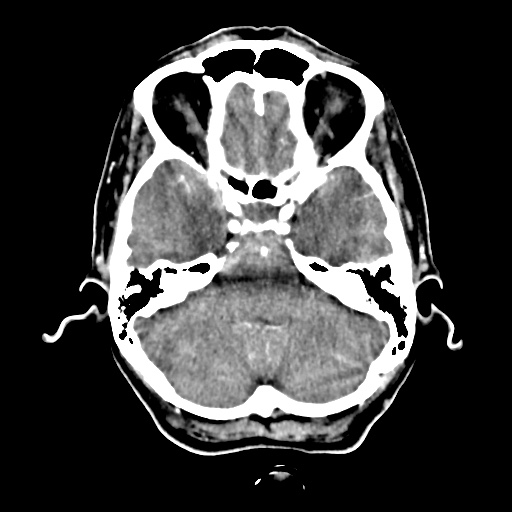 Aneursym related subarachnoid hemorrhage with hydrocephalus (Radiopaedia 45105-49084 D 13).jpg