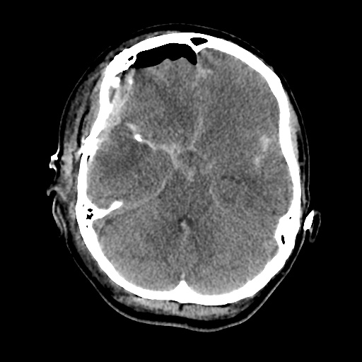 Aneursym related subarachnoid hemorrhage with hydrocephalus (Radiopaedia 45105-49085 Axial non-contrast 16).jpg