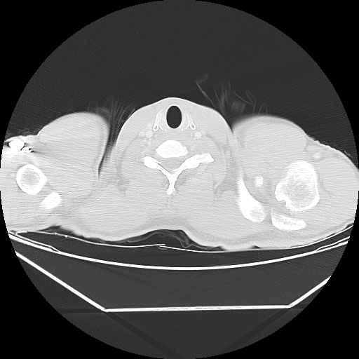 File:Aneurysmal bone cyst - rib (Radiopaedia 82167-96220 Axial lung window 4).jpg