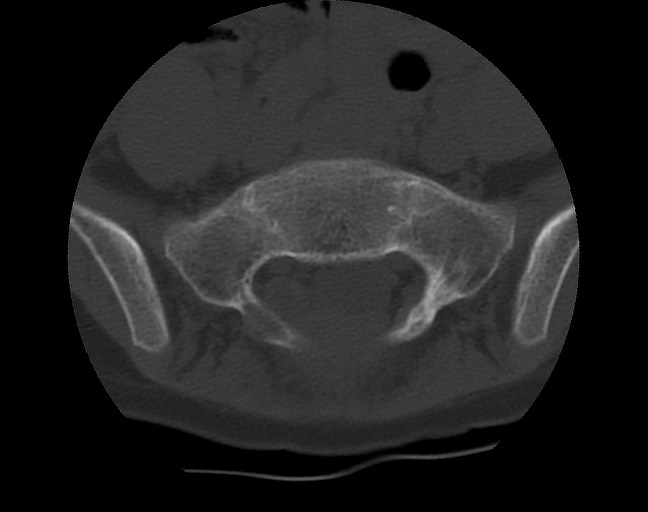 Aneurysmal bone cyst - sacrum (Radiopaedia 65190-74195 Axial bone window 18).jpg