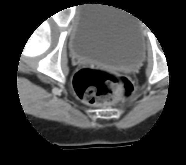 File:Aneurysmal bone cyst - sacrum (Radiopaedia 65190-74195 Axial non-contrast 44).jpg