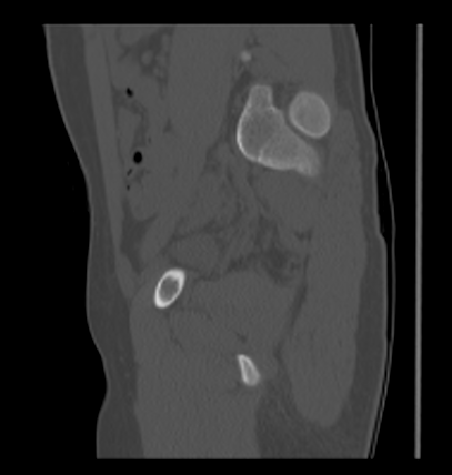 Aneurysmal bone cyst of ischium (Radiopaedia 25957-26094 Sagittal bone window 28).png