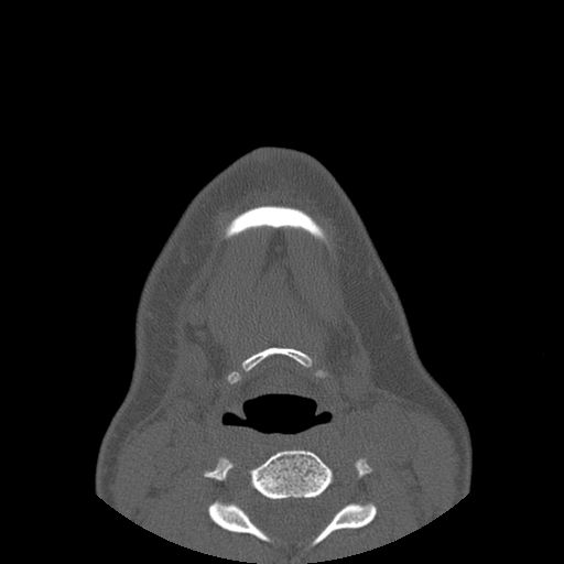 Aneurysmal bone cyst of the mandible (Radiopaedia 43280-46823 Axial bone window 5).jpg