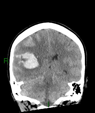 File:Aneurysmal subarachnoid hemorrhage with intra-axial extension (Radiopaedia 84371-99699 Coronal non-contrast 29).jpg