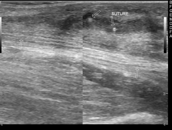 File:Ankle sinus (Radiopaedia 12913-13017 E 1).jpg