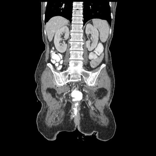File:Anorectal carcinoma (Radiopaedia 44413-48064 B 61).jpg