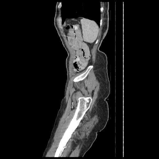 Anorectal carcinoma (Radiopaedia 44413-48064 C 100).jpg