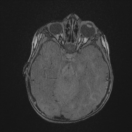 File:Anoxic brain injury (Radiopaedia 79165-92139 Axial MRA 79).jpg