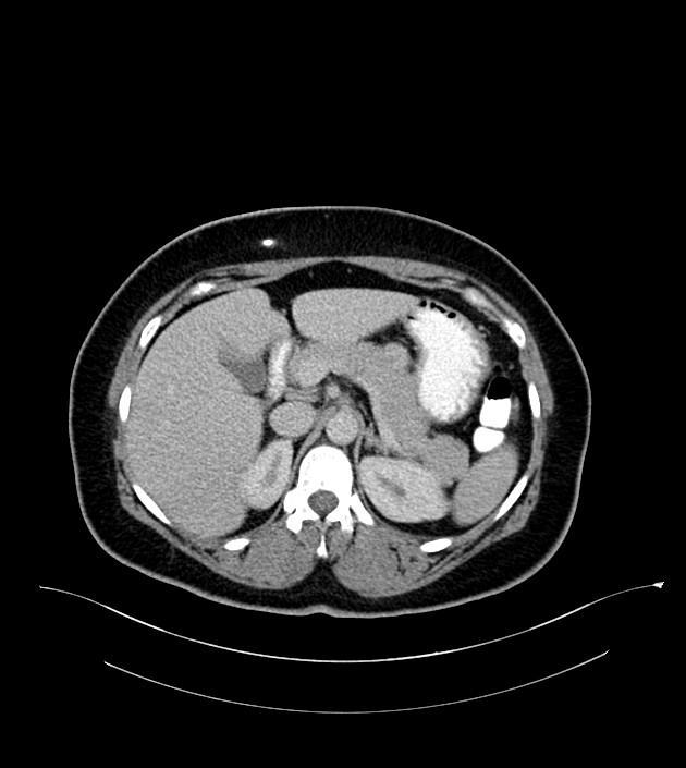 Anterior abdominal wall CSF pseudocyst (CSFoma) (Radiopaedia 79453-92571 A 30).jpg