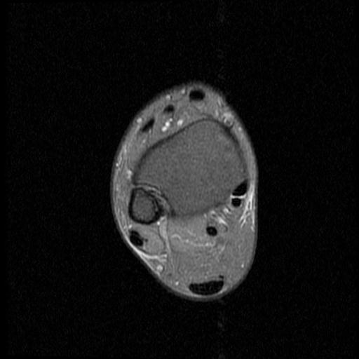 File:Anterior calcaneal process fracture (Radiopaedia 71377-81705 Axial PD fat sat 2).jpg