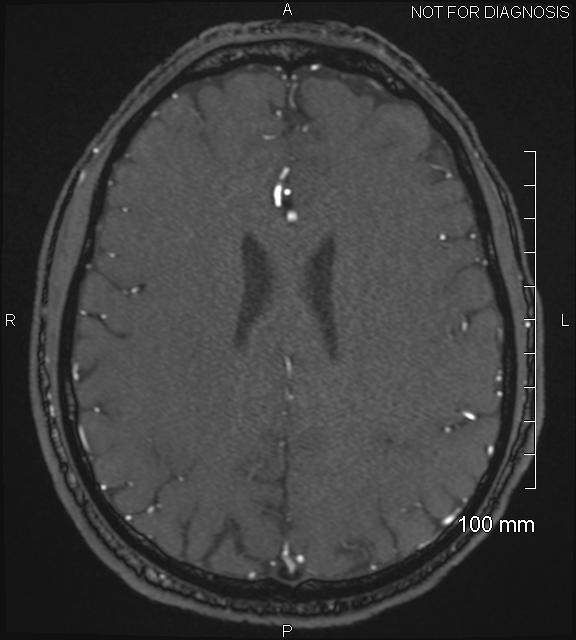 Anterior cerebral artery aneurysm (Radiopaedia 80683-94127 Axial MRA 166).jpg