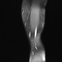 File:Anterior cruciate ligament full thickness tear (Radiopaedia 66268-75467 Sagittal PD fat sat 1).jpg