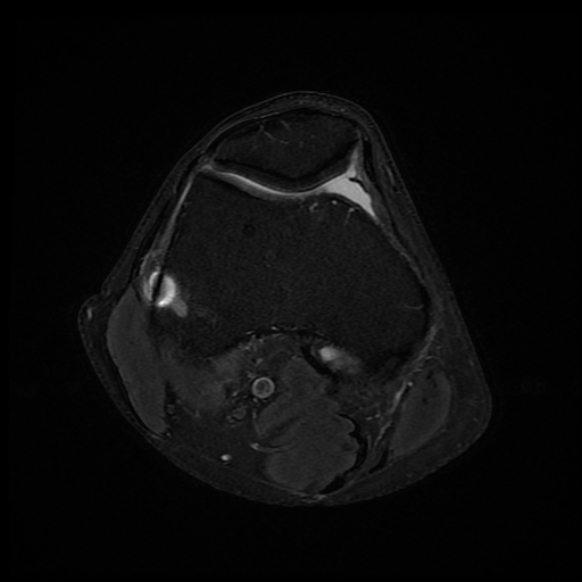 File:Anterior cruciate ligament graft tear and bucket-handle tear of medial meniscus (Radiopaedia 75867-87254 Axial PD fat sat 19).jpg
