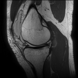 Anterior cruciate ligament rupture with Segond fracture (Radiopaedia 69043-78806 Sagittal PD 69).jpg