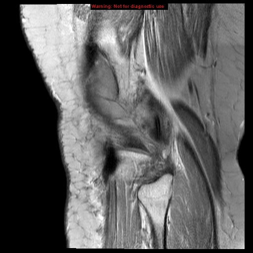 File:Anterior cruciate ligament tear (Radiopaedia 12329-12612 Sagittal T2 fat sat 2).jpg