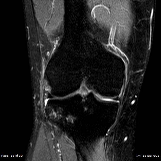 File:Anterior cruciate ligament tear (Radiopaedia 70783-80964 Coronal STIR 18).jpg