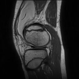 Anterior cruciate ligament tear - pediatric (Radiopaedia 62152-70260 Sagittal PD 134).jpg