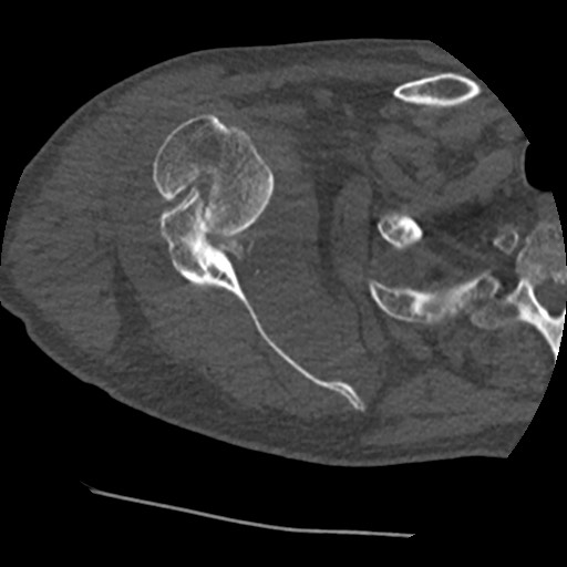 Anterior glenohumeral dislocation with Hill-Sachs lesion (Radiopaedia 62877-71249 Axial bone window 40).jpg
