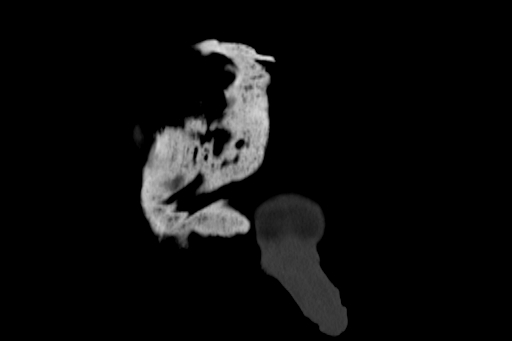 Anterior inferior iliac spine avulsion injury (Radiopaedia 88666-105376 Coronal bone window 6).jpg