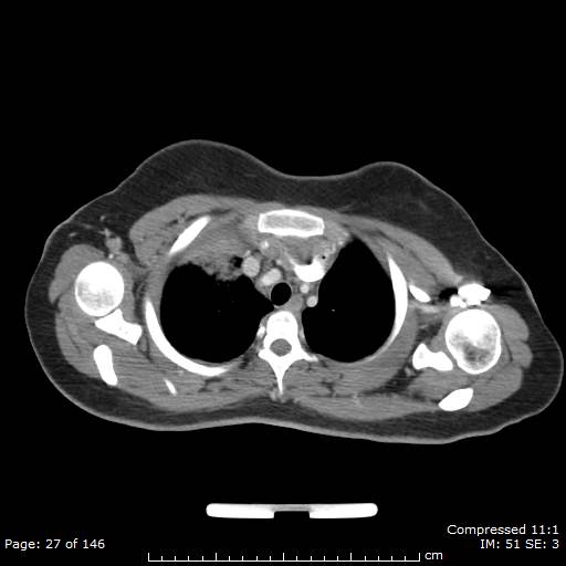 Anterior mediastinal B cell Lymphoma (Radiopaedia 50677-56114 A 14).jpg