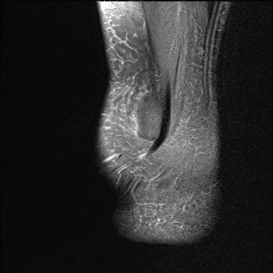 File:Anterior talofibular ligament injury - rupture with soft-tissue impingement (Radiopaedia 38765-40928 Sagittal PD fat sat 20).jpg