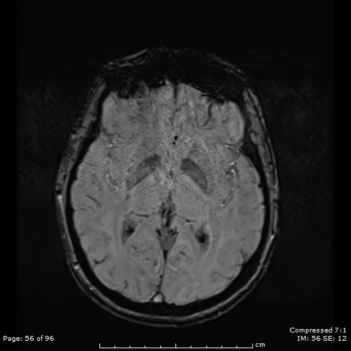 Anterior temporal lobe perivascular space (Radiopaedia 88283-104914 Axial SWI 25).jpg