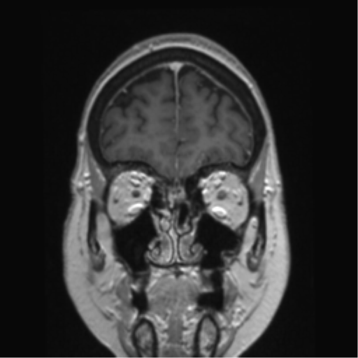 Anterior temporal pole cysts (Radiopaedia 46629-51102 Coronal T1 C+ 142).png
