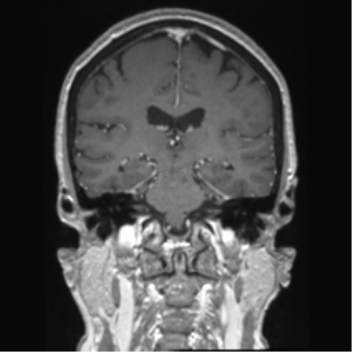 Anterior temporal pole cysts (Radiopaedia 46629-51102 Coronal T1 C+ 76).png