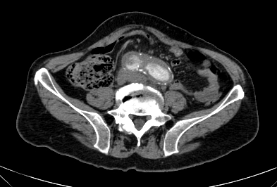 Anterior vertebral scalloping (abdominal aortic aneurysm) (Radiopaedia 66744-76067 F 65).jpg