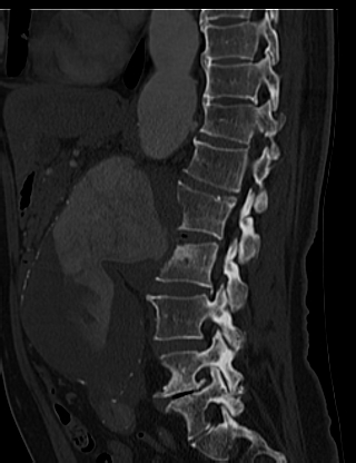 File:Anterior vertebral scalloping (abdominal aortic aneurysm) (Radiopaedia 66744-76067 Sagittal bone window 23).jpg